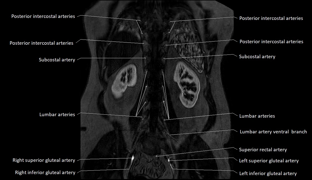 MRA Abdomen coronal anatomy image 48.webp